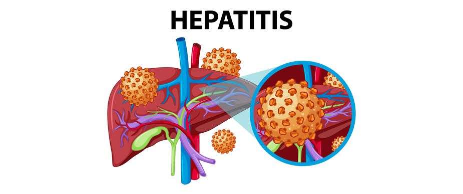 Kulgam village reports Hepatitis case, one dead, another hospitalized